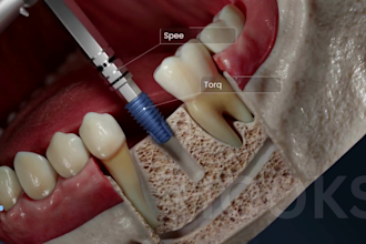 do 3d dental implant animation 3d medical device and 3d surgical ani