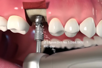 create 3d medical animation dental implant surgical procedure explainer video