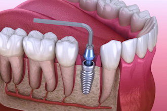 3d dental animation 3d medical animation 3d surgical animation tooth bone graft