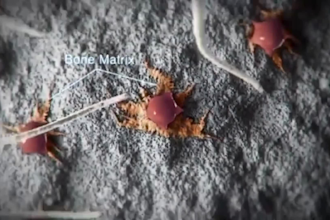 create 3d dental implant, bone graft and oral treatment surgery animation video
