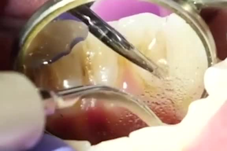 do video remove braces for whiten teeth