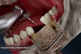 create 3d medical dental oral implant surgery and crown restoration animation