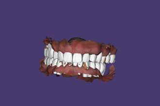 design zirconia crowns and bridges, ready by your morning