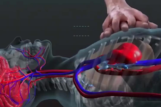 do 3d medical device animation 3d medical explainer 3d surgical device animation