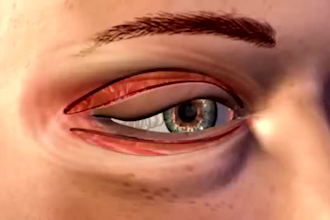 create 3d medical animation, surgery explainer video, medical device bio medical