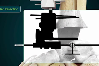 create 3d orthopedic implant medical device animation