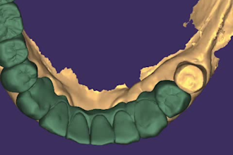 professional dental cad crown and bridge design in exocad