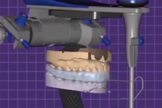 design custom cad night guards and occlusal splints