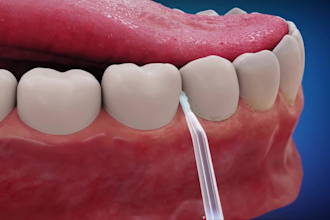 4k 3d medical surgery and device explainer animation video