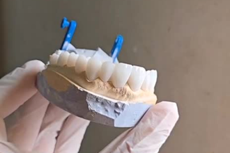 design professional dental crowns, bridges and implant restorations using exocad