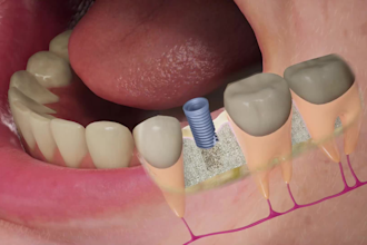create 3d medical animation, dental animation, dental implant, 3d dental video
