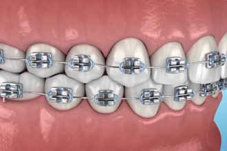create 3d medical animation, orthodontic dental explainer and brace video