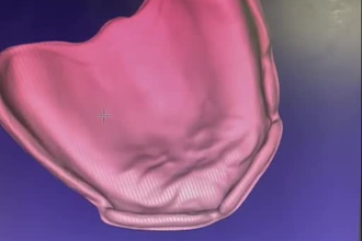 digital dental cad design, aligners, implants, dentures