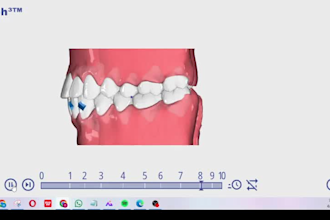 create onyxceph 3d clear aligner treatment plans and aligner setups
