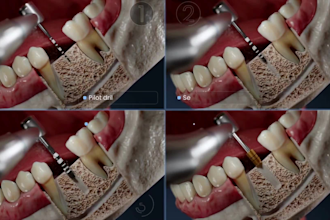 do 3d medical animation dental implant procedure, tooth anatomy explainer video