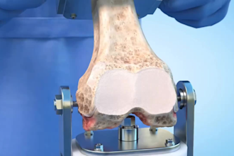create medical animation, 3d knee replacement surgery, joint implant animation
