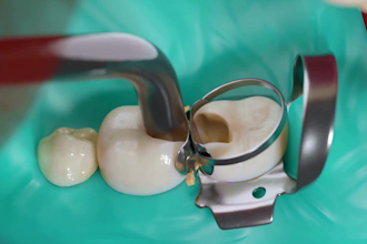 create dental implant animation caries removal and dental device explainer video