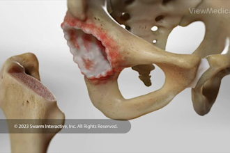 3d medical animation, surgery explainer video, medical device pharmaceutic moa