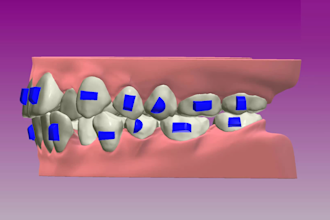 make accurate clear aligner setups with 3shape