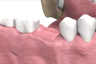 create realistic 3d dental implant procedure animation for your clinic