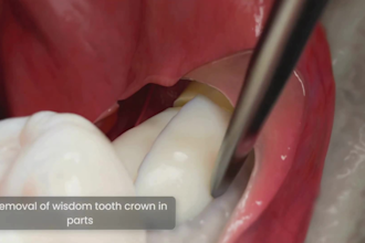 create 3d dental animation, dental procedure, dental implant and oral surgery