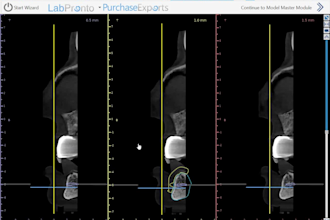 do implant planning ,surgical guide using blue sky and b4d