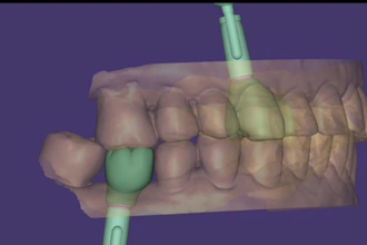 dental cad designer, exocad, crown, bridge, implant design