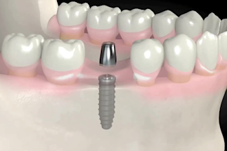 create 3d dental animation implant and dental explainer video