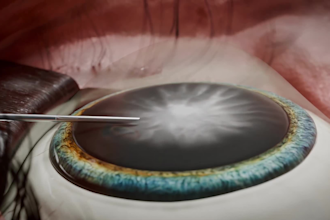 create 3d medical animation cataract surgery and iol implantation video