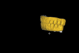 screw retained prosthesis crowns, bridges, full arch
