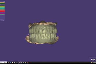 design aox restorations , custom abutments and implant crowns in exocad