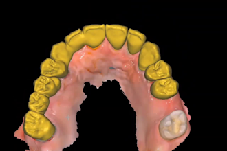 design dental crowns, bridges and implants in exocad