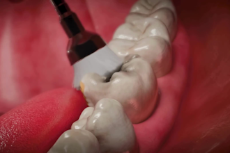 do 3d dental implant animation, root canal treatment explainer and orthodontic