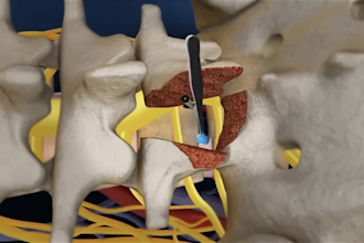 create a 3d medical animation surgical procedure and medical explainer video