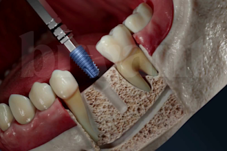 do 3d dental implant surgery animation 3d oral implant procedure video animation