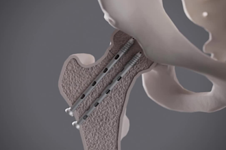 3d medical animation, medical product animation, biomaterial, product video, cgi