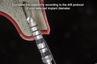 do 3d dental implant animation cosmetic surgical procedure explainer video ads