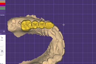 design professional dental cad crwonbridge using exocad