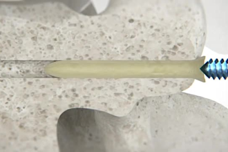 create realistic 3d medical product animation, cgi animation, promo video ads