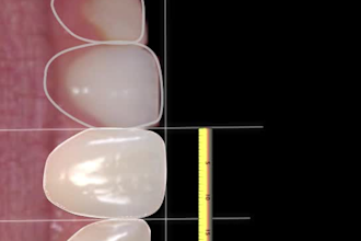 design a realistic digital smile design for dental treatment planning