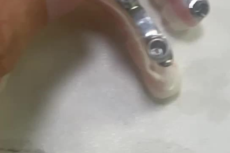 do exocad dental implant design fast and accurately