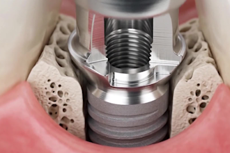 do 3d dental implant animation 3d crown tooth procedure  3d oral surgery
