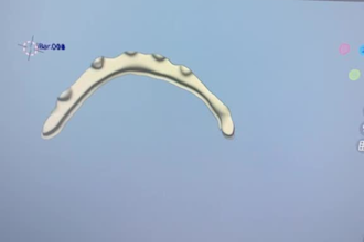do exocad design , b4d , onyxceph , 3shape