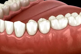 create 3d dental animation 3d ai medical explainer 3d ai dental implant surgery