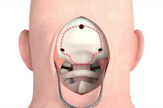 create 3d surgical animation for neurosurgery cardiac and transplant