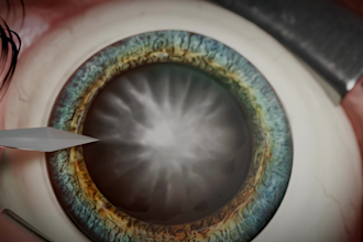 create 3d medical animation, cataract surgery animation, ophthalmology videos