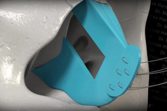 do 3d medical animation, septoplasty nasal spreader graft, rhinoplasty  surgery