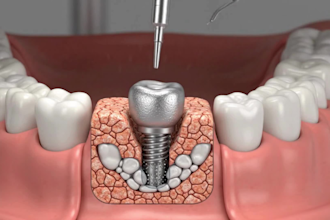 ai medical device animation, surgical animation and medical explainer video