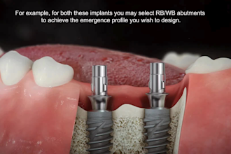 do 3d dental implant animation medical device explainer surgical procedure video