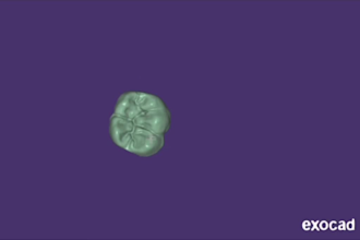 design professional dental crowns,bridges on exocad